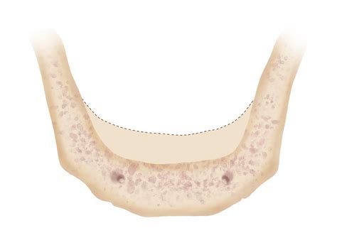 Bone Resorption | IDIA | The Dental Implant Guide