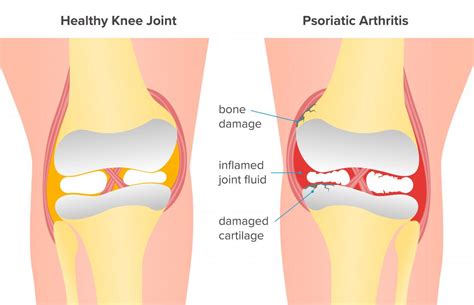 Psoriatic arthritis of the knee: Symptoms and treatment