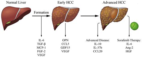 Liver Cancer Stages