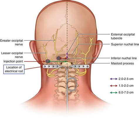 Occipital Nerve Stimulator for Pain Relief - Neuroaxis