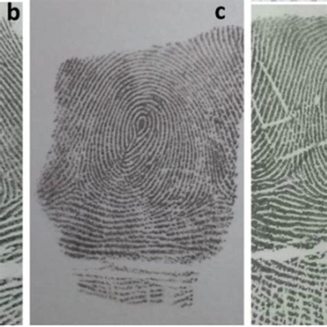 a An unusual fingerprint pattern named as a central pocket whorl. b An... | Download Scientific ...