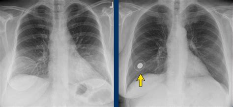 The Radiology Assistant : Breast Implants