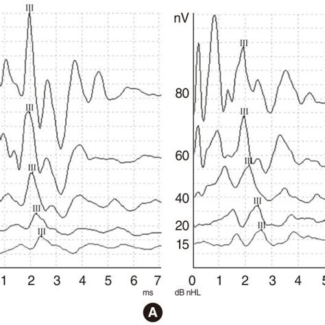 The auditory brainstem response findings before and after treatment in ...