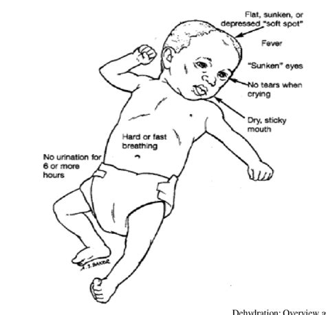 Signs of dehydration. Adapted and reprinted from Nationwide Children's... | Download Scientific ...