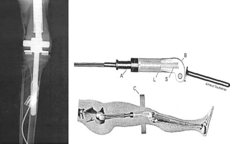 Expandable endoprosthesis for limb-sparing surgery in children: Long-term results - Amit Dotan ...