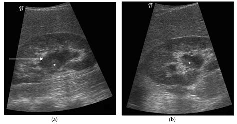 Diagnostics | Free Full-Text | Pyonephrosis Ultrasound and Computed Tomography Features: A ...