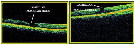 MACULAR OCT | Optometry Education