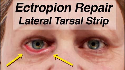 Ectropion Repair Using a Lateral Tarsal Strip (Lower Eyelid Drooping After Facial Paralysis ...