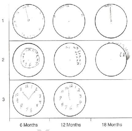 Examples of clock drawings showing deterioration in dementia, adopted ...