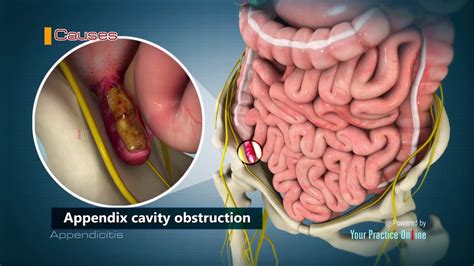 Symptoms of Appendicitis - YouTube