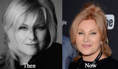 Deborra-Lee Furness Plastic Surgery Before and After Photos - Latest ...