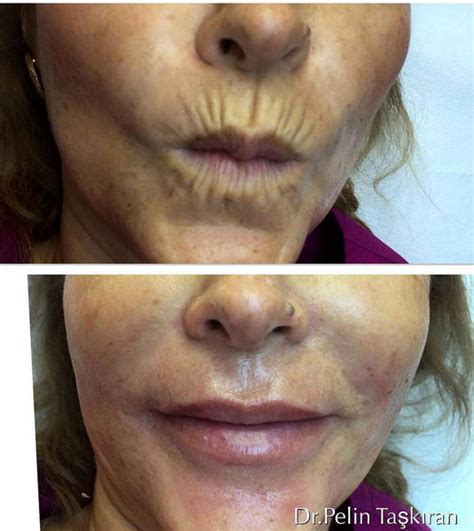 Botox On Smokers Lines Before And After Photos (10) » Facial Injections ...