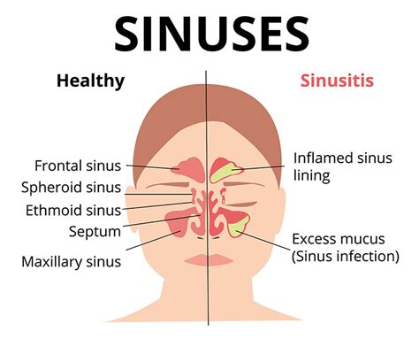 Chronic Sinusitis | Symptoms of Sinus Infection | Sinus Treatment