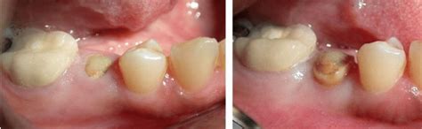 Crown lengthening - Dental Implants PA, Gum Disease PA, Implant dentist, Dental Implants Glen ...