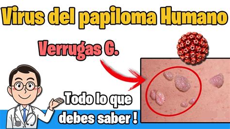 Tipos de VPH y prevención Virus de Papiloma Humano parte 2 YouTube ...