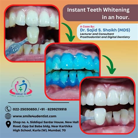 teeth whitening service in Kurla, teeth whitening service in Mumbai