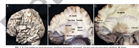 Subthalamic Nucleus Anatomy