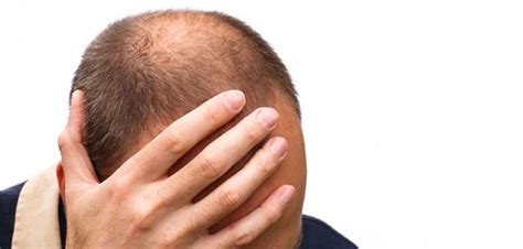 Hair Loss stress: 5 major causes with Treatment and Prevention