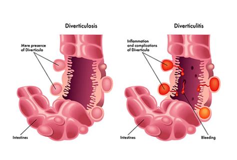 Diverticulitis Flashcards | Quizlet