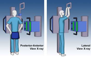 Chest Radiograph | Congenital Heart Disease - Cove Point Foundation ...