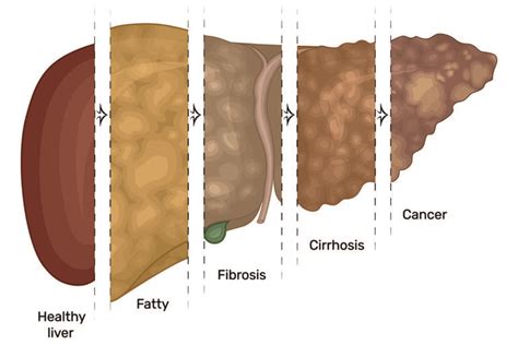 Liver Disease and Failure – St. Anthony's Hospice