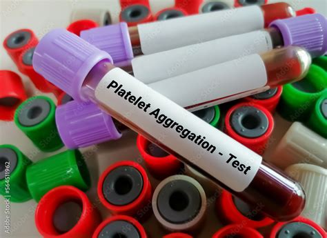 Platelet Aggregation test, diagnosis for various hereditary or acquired platelet disorders. Flow ...