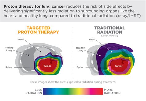 Fight Cancer With Protons – Provision CARES Proton Therapy Knoxville