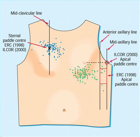 Do doctors position defibrillation paddles correctly? Observational ...