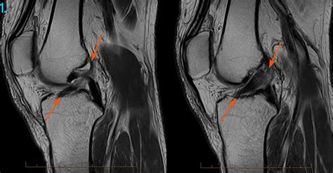 Knee Injuries Diagnostic Imaging , MRI, CT Scan