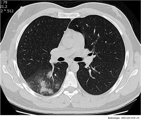 Ahorro Suave parálisis tac de torax ventana pulmonar esencia Arena ...