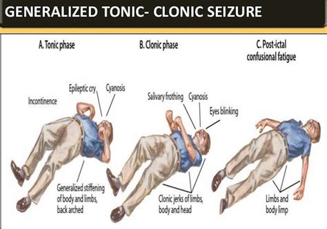 Tonic clonic seizure definition, first aid, causes, symptoms & treatment