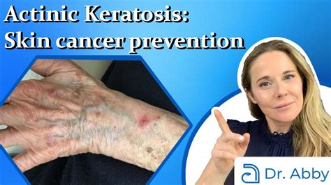 Actinic Keratosis: Skin cancer prevention you need to start in your 30s ...