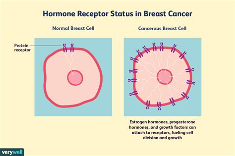 Hormone Receptor Status and Diagnosis in Breast Cancer