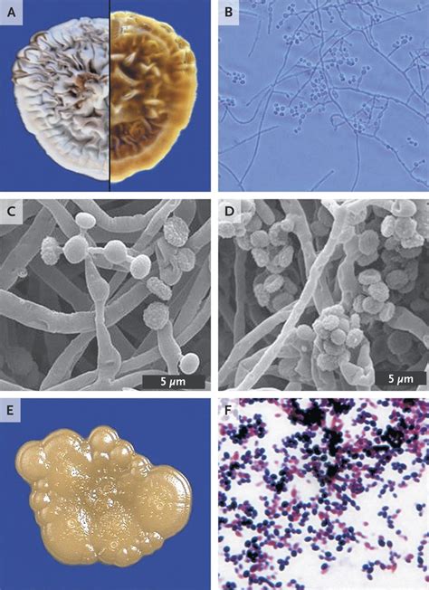 A Dimorphic Fungus Causing Disseminated Infection in South Africa | NEJM