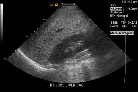 Fatty liver ultrasound - wikidoc