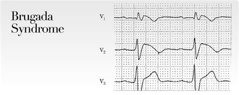 Brugada Syndrome | Ruth Kam Heart & Arrhythmia Clinic