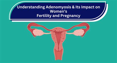 Successful Pregnancy With Adenomyosis