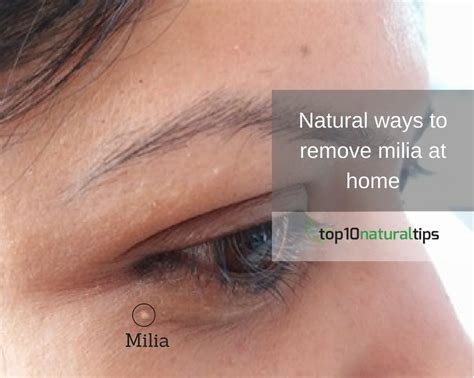 treatment for milia on face | Top10 Natural Tips