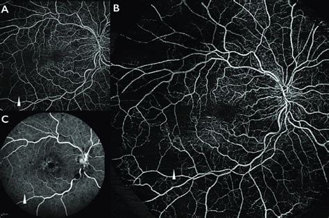 Swept-source optical coherence tomography angiography (SS-OCTA) and... | Download Scientific Diagram