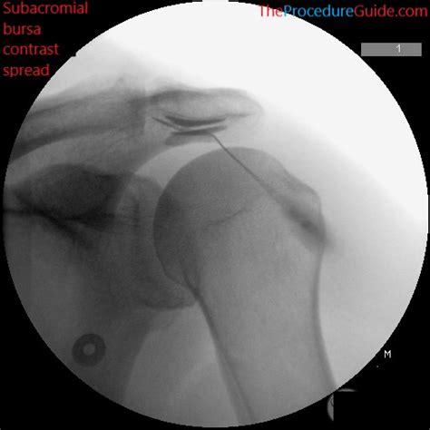 Fluoroscopic Guided Shoulder Subacromial Bursa (SAB) Injection – Technique and Overview - The ...