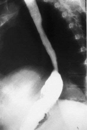 Open Collis Gastroplasty | Thoracic Key