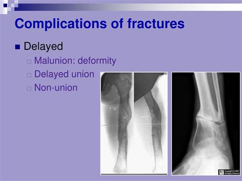 PPT - Bone Fracture and healing PowerPoint Presentation, free download - ID:2024176