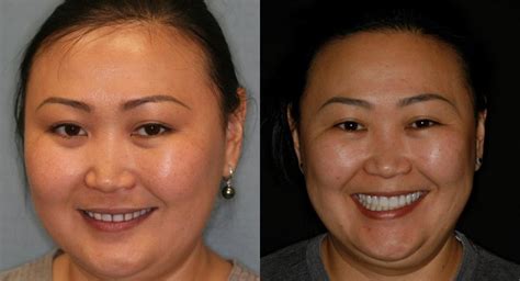 Laser Gum Lift in Houston, TX - Cosmetic Dental Procedures