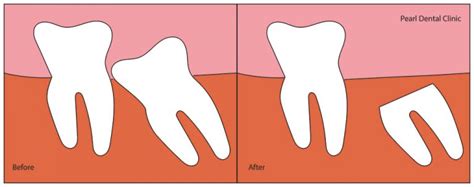 Coronectomy - Dentist Kingston