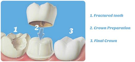 Everything you need to know about Dental Jacket - #1 DENTIST IN ...