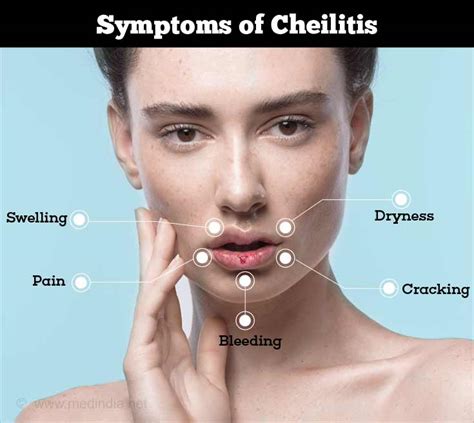 Cheilitis - Causes, Symptoms, Diagnosis & Treatment