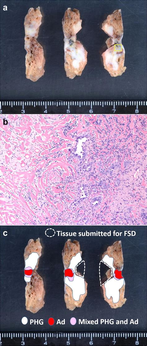 a Cut surface of the wedge resection specimen showing a distinct... | Download Scientific Diagram