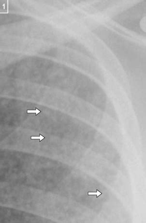 Miliary TB | Radiology Key