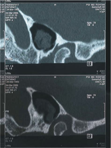 Figure 1 from Osteoma Of Surgical Mastoid Cavity –A Case Report | Semantic Scholar