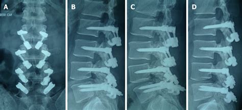 Surgical treatment of four segment lumbar spondylolysis: A case report